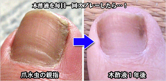 足の爪水虫の画像写真