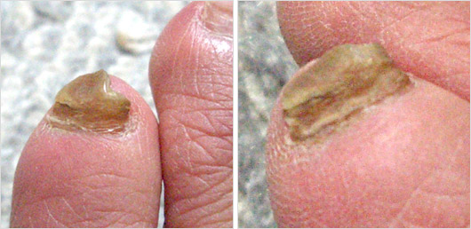 足の爪水虫の画像写真