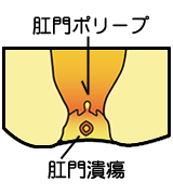 慢性裂肛の図