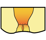 急性裂肛の図