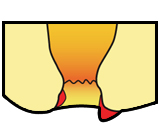 血栓性外痔核の図