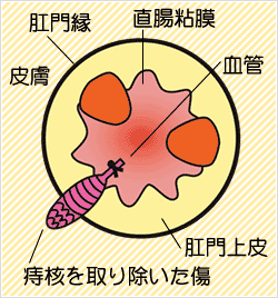 いぼ痔の手術画像（結紮切除法）
