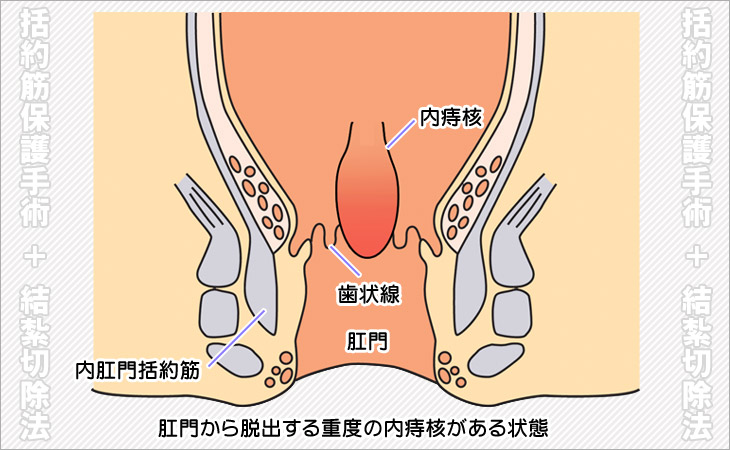 いぼ痔の手術画像（結紮切除法）